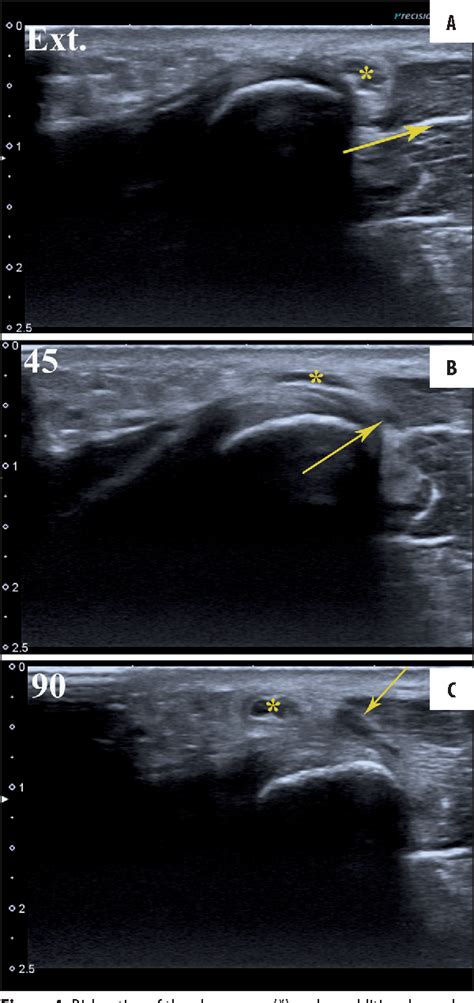 Figure 1 From The Snapping Elbow Syndrome As A Reason For Chronic Elbow
