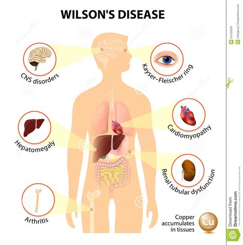 Wilson s disease stock vector. Illustration of dystonia - 54105539