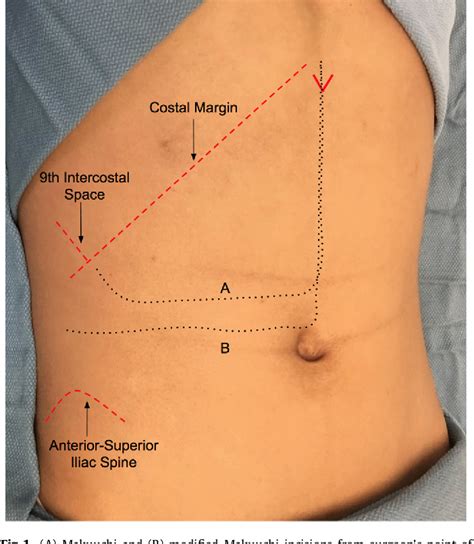 Figure 1 From Open Adrenalectomy Through A Makuuchi Incision A Single