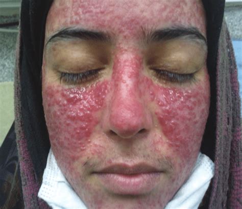 Severe Papular And Pustular Eruptions On The Forehead Face And Nose