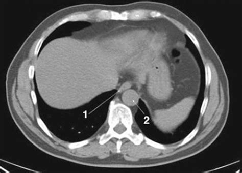 Image Noncontrast Ct Scan Of The Abdomen And Pelvis Showing Normal
