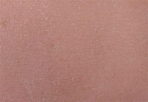 This Is Pigmentation Chicken Skin On Arms I Try This Way