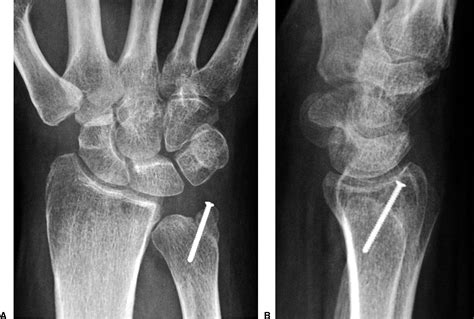 Oblique Ulnar Styloid Osteotomy—a Treatment For Ulnar Styloid Impaction