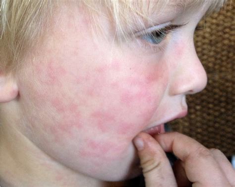 Common Skin Rashes In Children 2022