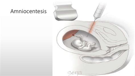 Antenatal Prenatal Diagnosis Of Genetic Disorders Diseases Dr