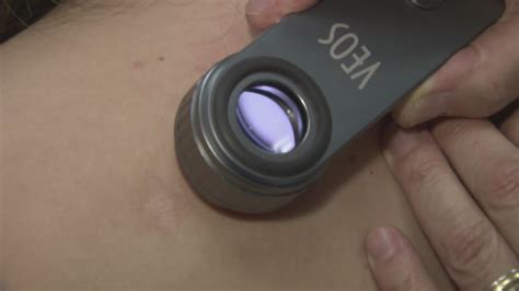 New Device Helps Detect Skin Cancer Youtube