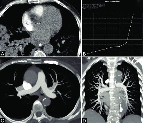 A D Ct Pulmonary Angiography Ctpa On A Dect Scanner A Roi