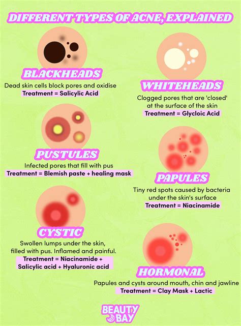 6 Different Types Of Acne Explained Beauty Bay Edited Different