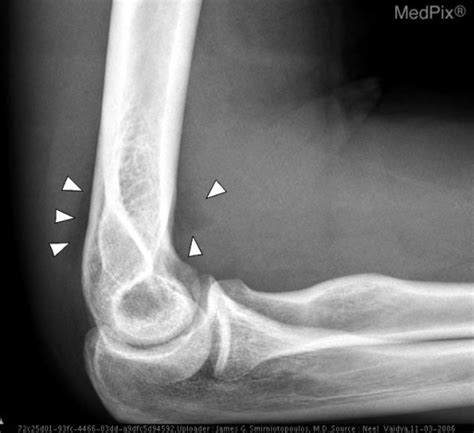 Lateral View Of The Right Elbow Demonstrates Anterior A Open I