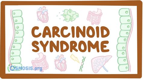 carcinoid syndrome causes symptoms diagnosis treatment pathology youtube