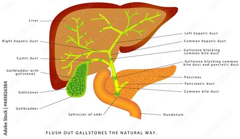 Gallstones In The Gallbladder Human Liver And Gallbladder Anatomy
