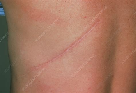 Learn about your lungs and respiratory system, how your muscles and nervous system control your breathing, and nhlbi research on the lungs. Pneumonectomy scar: removal of a lung - Stock Image M332/0028 - Science Photo Library