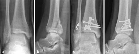 Posterior malleolar fractures of the ankle | SpringerLink