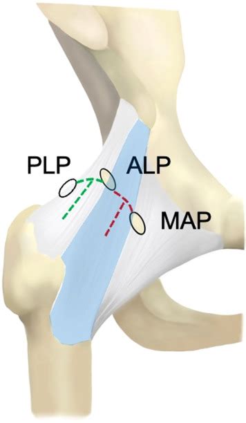 Lateral T Capsulotomy With Hip Arthroscopy For Access And Excision Of