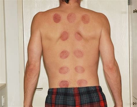 What Is Cupping Heal With Acupuncture