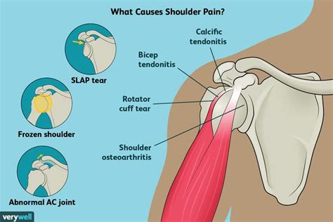 Causes Of Shoulder Pain Shoulder Pain Relief Body Pain Relief