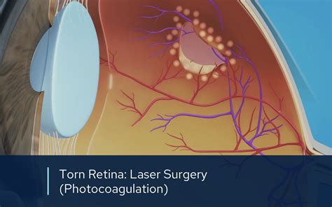 Retinal Videos Retinal Consultants Medical Group