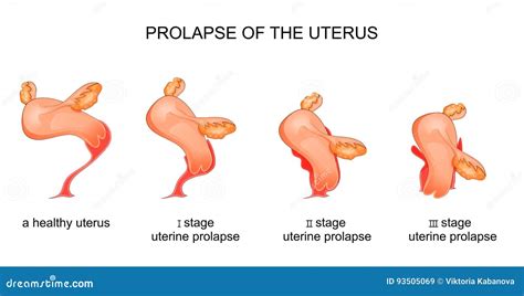 Etapas Del Prolapso Uterino Ilustraci N Del Vector Ilustraci N De