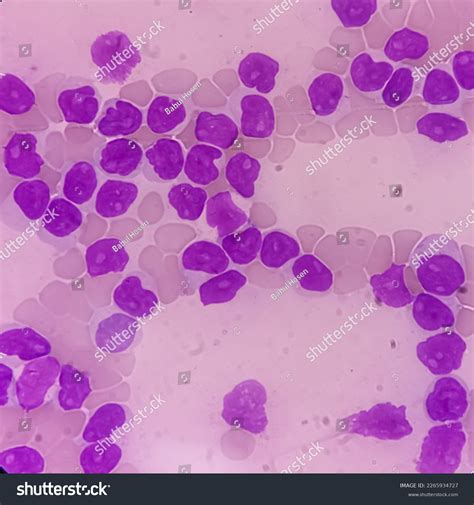 Lymphocytosis Thrombocytopenia Smear Show White Blood Stock Photo