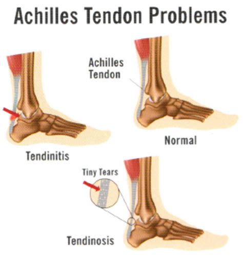 The achilles tendon attaches your calf muscles to your heel bone, or there are two types of achilles tendonitis: Amniofix - Northeast Foot Care PLLC, podiatrist in ...