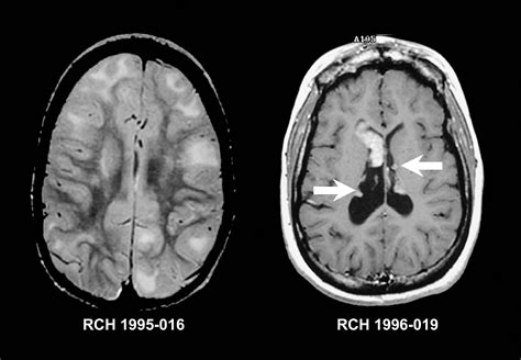 Mri Brain T2 | Goji Actives Diet