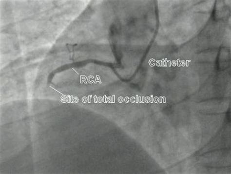 Total Occlusion Of Right Coronary Artery All About Cardiovascular