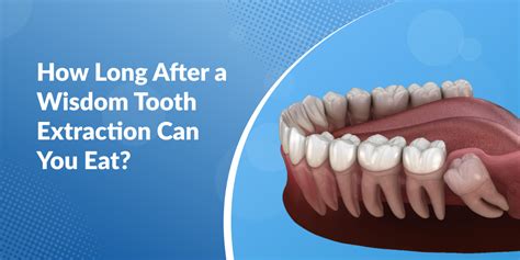 How Long After A Wisdom Tooth Extraction Can You Eat La Dental Clinic