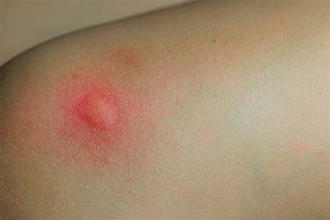 Mosquito Bite Stock Photos Pictures And Royalty Free Images Istock