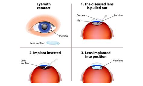1 [middle english, from middle french or medieval latin; All You Need to Know about Cataract Surgery | Health Plus ...