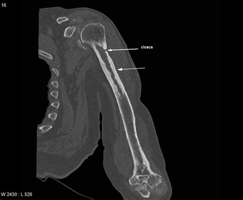 Osteomyelitis Suspected Acute