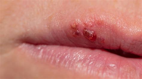 Mouth Sores Pictures Causes Types Symptoms And Treatments In 2022