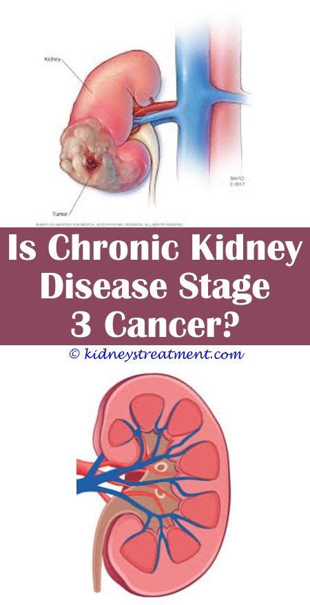 Chronic kidney disease (ckd) is diagnosed based on evaluation of all available clinical and diagnostic information in a stable patient. Stage 4 Kidney Disease Cats Life Expectancy - KIDKADS