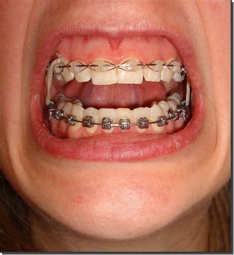 Each give a smile orthodontist welcomes at least one patient per year into his her practice to receive free braces. how-much-do-braces-cost | Step 3: Charitable organizations ...