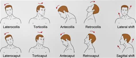 Which Muscles Are Involved In Torticollis