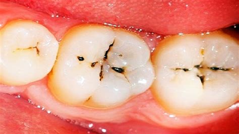 This web page explains how the tooth decay process starts and how it can be stopped or even reversed to. How To Know When They Cavities | Dentist In Huntersville NC