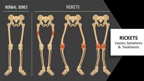 Rickets In Children With Image Discussion Rickets Causes Symptoms