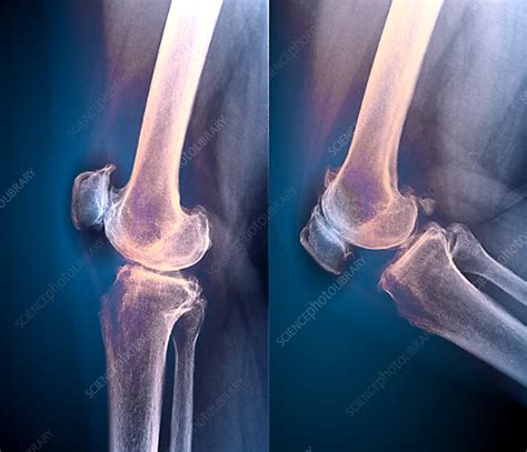 Osteoarthritis Of The Knee X Rays Stock Image C0472769 Science