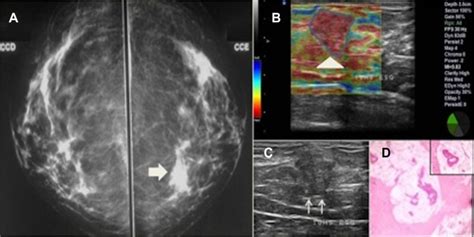 Mucinous Carcinoma In A 58 Year Old Patient Notes The Mammogram Shows