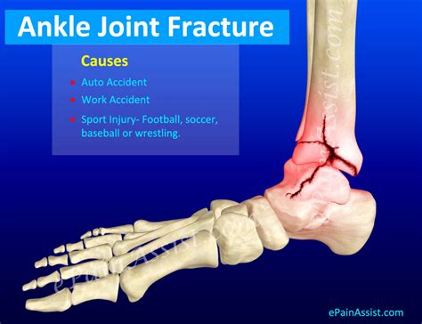 Ankle Joint Fracture Types Classification Symptoms Treatment