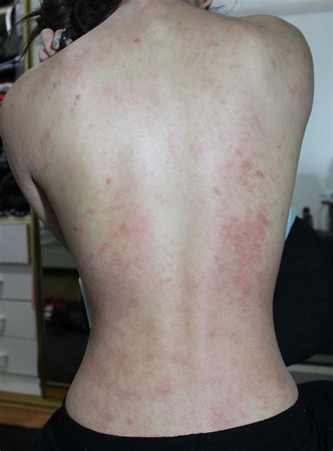 Is This Rash Caused By Candida At Candida And Dysbiosis Forum With