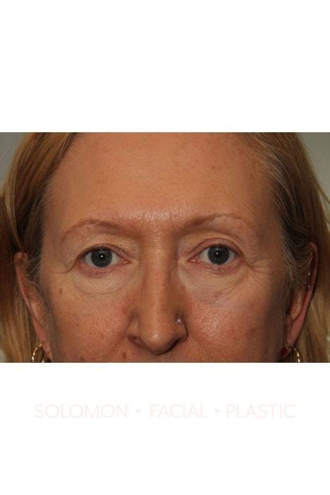 Patient 29 Solomon Facial Plastic