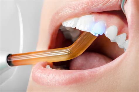 The Science Behind Dental Fillings How They Work And Why You Need Them