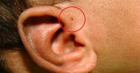 Have You Seen Someone With A ‘tiny Hole Above Their Ears This Is What
