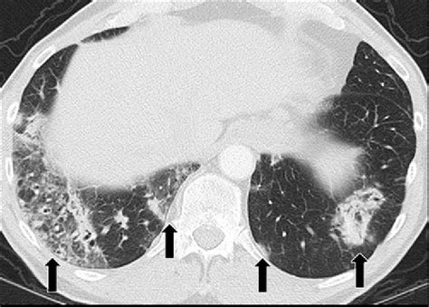 000 Cryptogenic Organizing Pneumonia Cop And Organizing Pneumonia