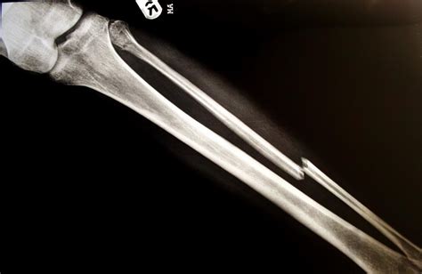 Broken Leg Bone X Ray