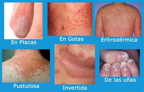 Cbd Y Psoriasis Tienda Cbd