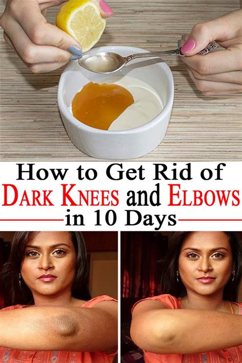 How To Get Rid Of Dark Knees And Elbows In 10 Days Fashion Daily