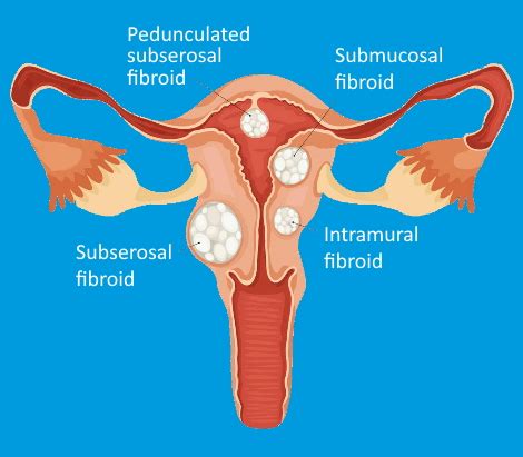 Learn More About Fibroids Risk Factors Symptoms Treatment Options