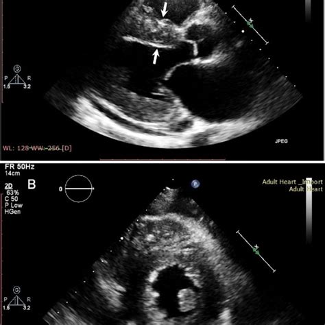 Two Dimensional Speckle Tracking Strain Imaging Of Echocardiography In