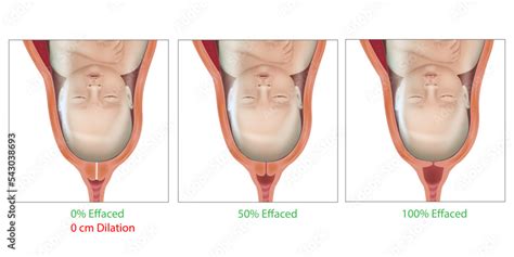 Vetor De Cervical Effacement And Dilation During Delivery Cervix Labor Or Delivery Cervix